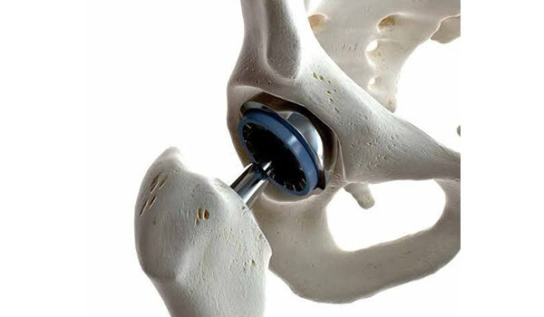 Hip Replacement Recovery: Q&A with a Hip Specialist