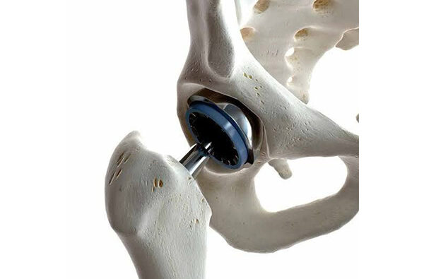 Hip Replacement Recovery: Q&A with a Hip Specialist