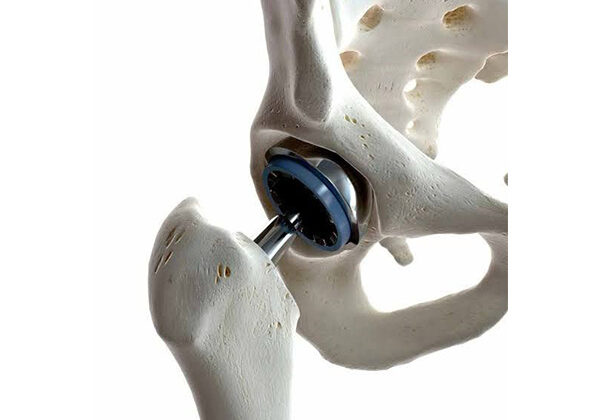 Hip Replacement Recovery: Q&A with a Hip Specialist
